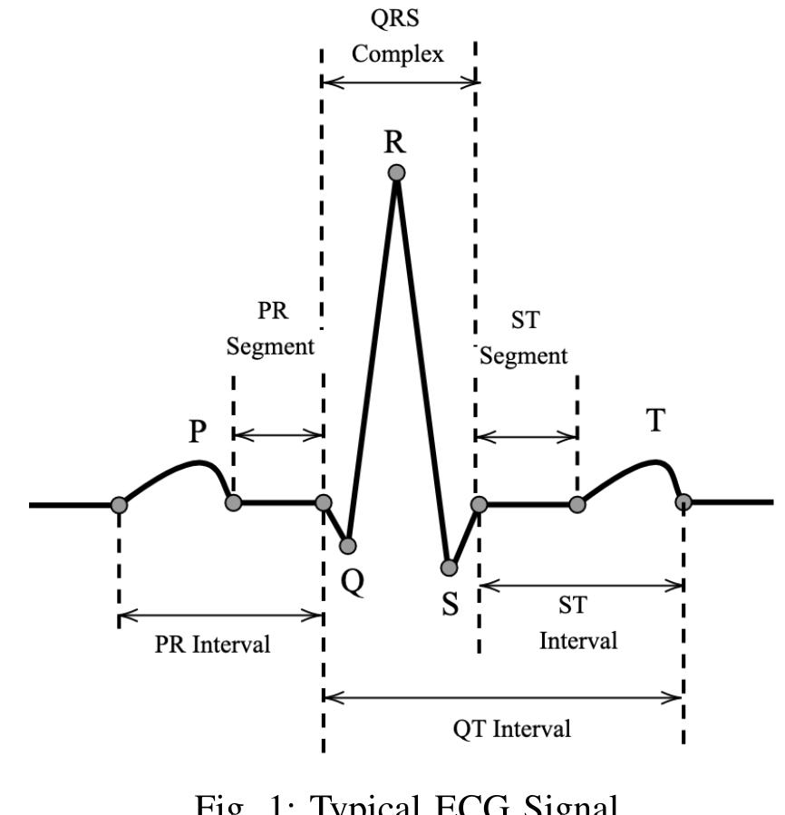 Tareque Bashar Ovi*, Sauda Suara Naba!, Dibaloke Chanda? and Md. Saif Hassan Onim § Department of Electrical, Electronic and Communication Engineering, Military Institute of Science and Technology (MIST) Dhaka-1216, Bangladesh  introduced. This aids in more precise diagnosis of patients and offers better treatment than empirical procedures. Even in the case of a fully automated and computerized system, it’s not an easy process, considering the presence of external noise and uneven classes in the dataset. The accuracy achieved applying machine learning is insufficient as well. Multiple attempts have been made to incorporate deep learning algorithms to address and solve the issue of precisely classifying cardiovascular diseases with a lower number of false positive detections. 