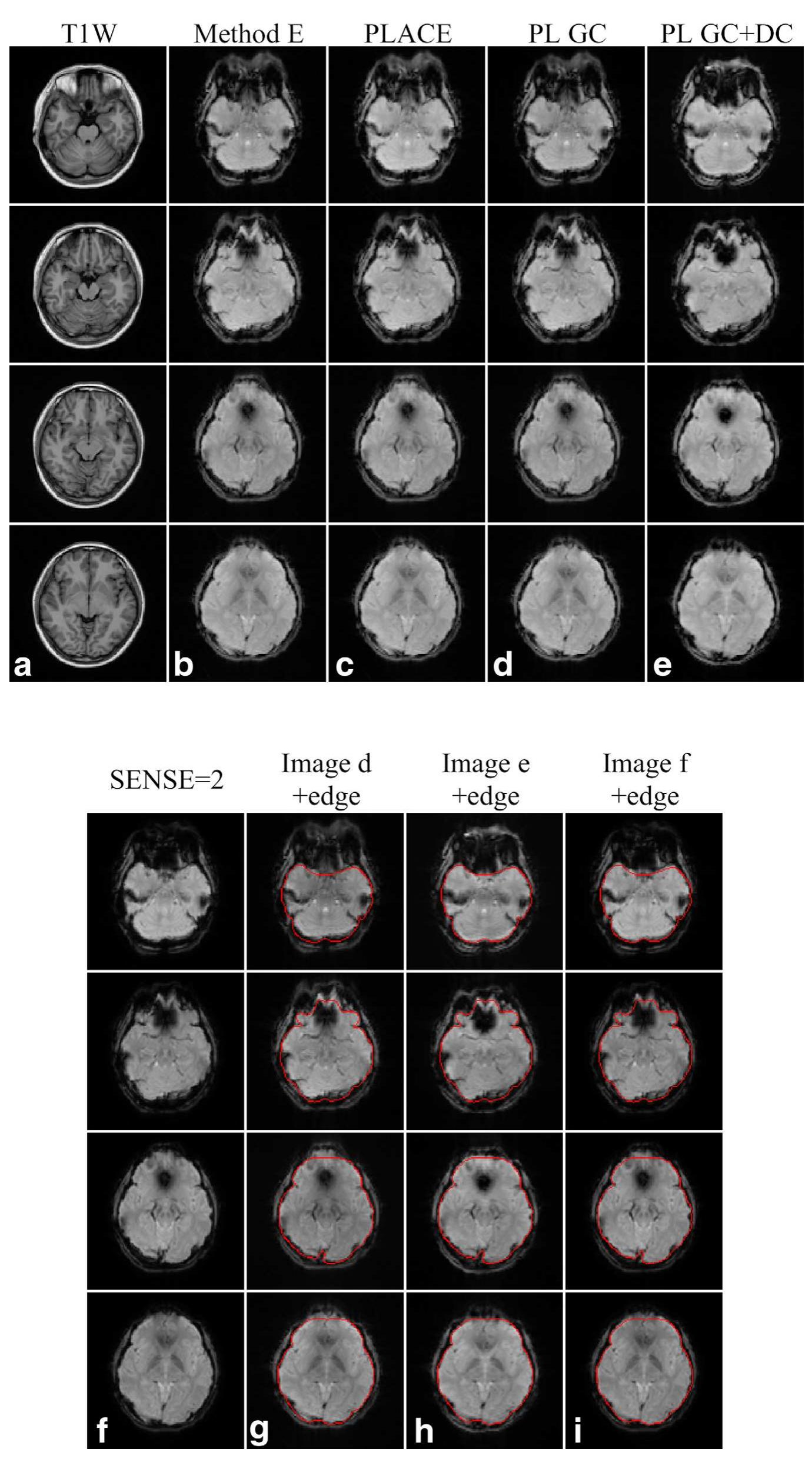 (PDF) EPI Nyquist ghost and geometric distortion correction by two ...