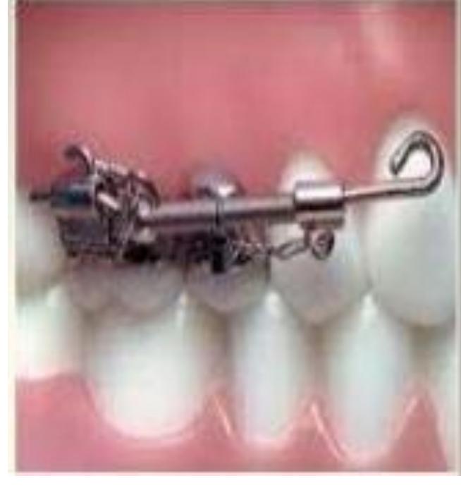 (PDF) Molar distalization – A review