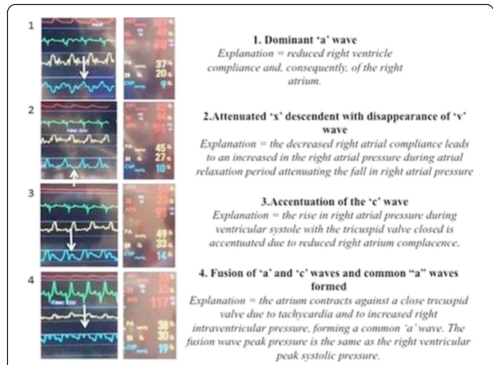 (abstract p150). central venous pressure waveform tracings.