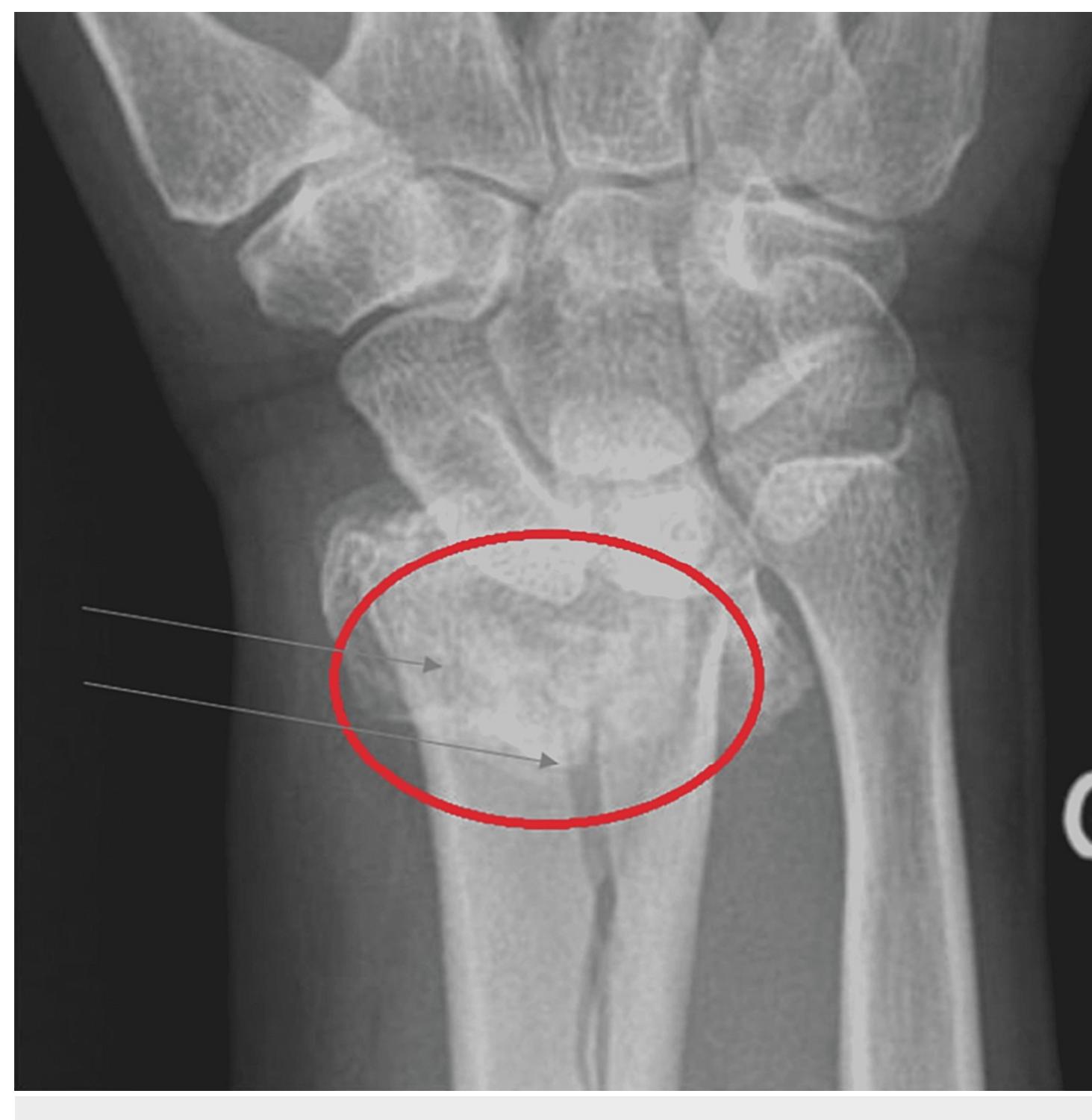 Figure 1 From Osteoporosis A Step By Step Case Based