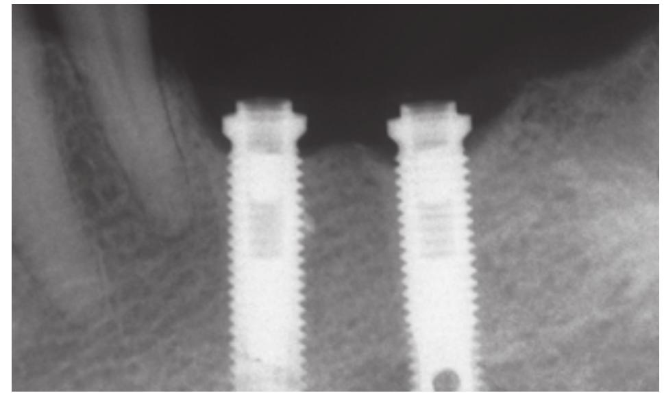 Multan Api Cal C a periapical radiograph shows that the api- cal portions
