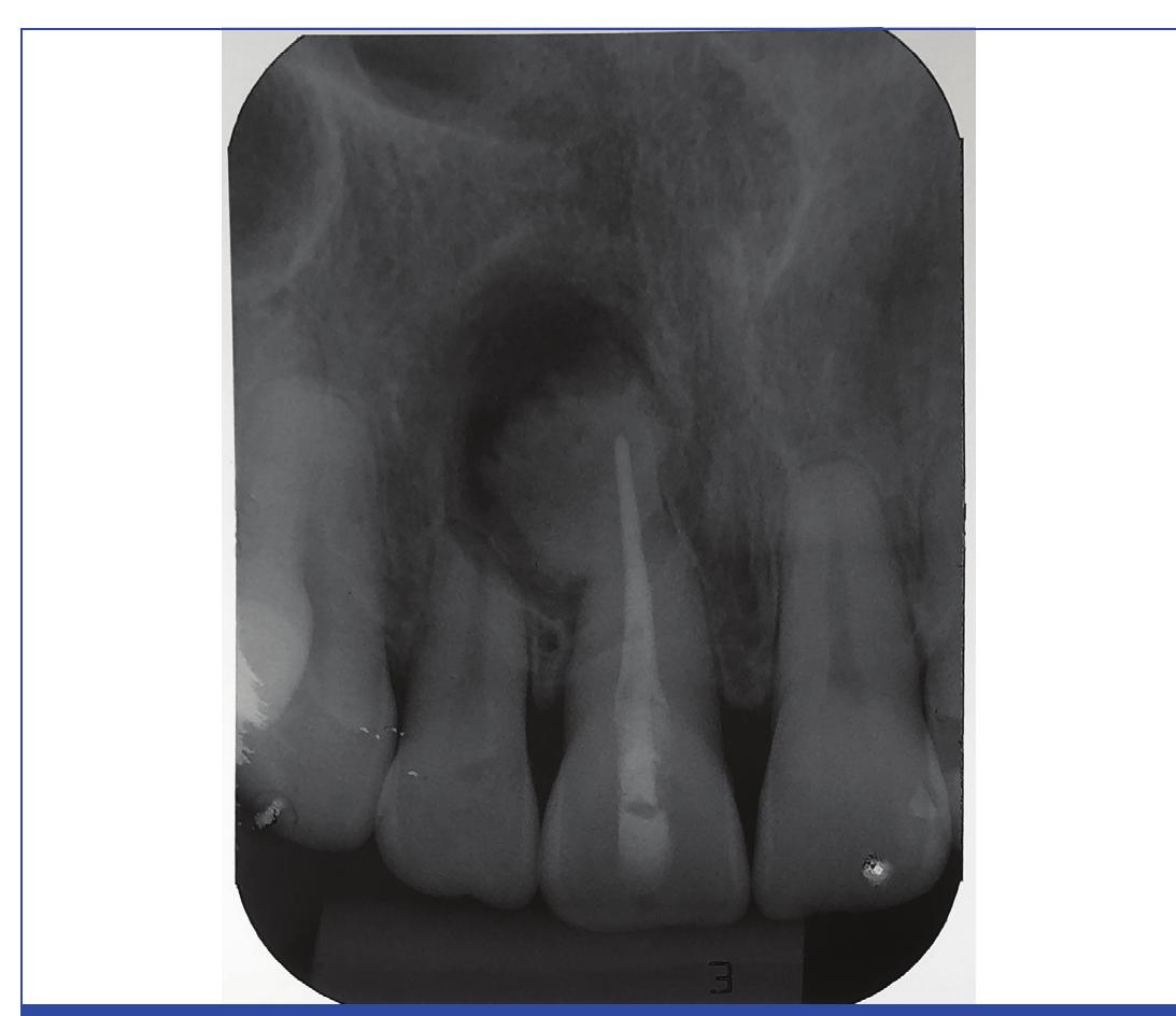 [table/fig-3]: initial periapical radiograph