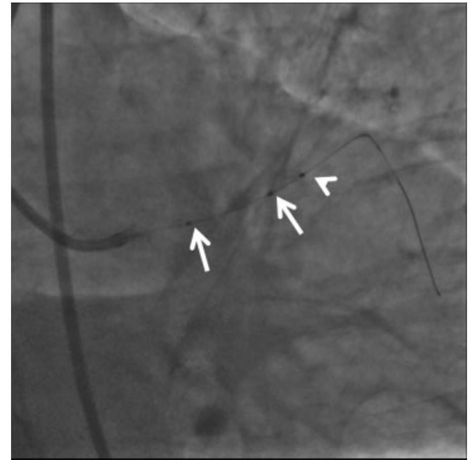 Cath Angles Rao Rao caudal view showing proximal two markers (arrows) of the