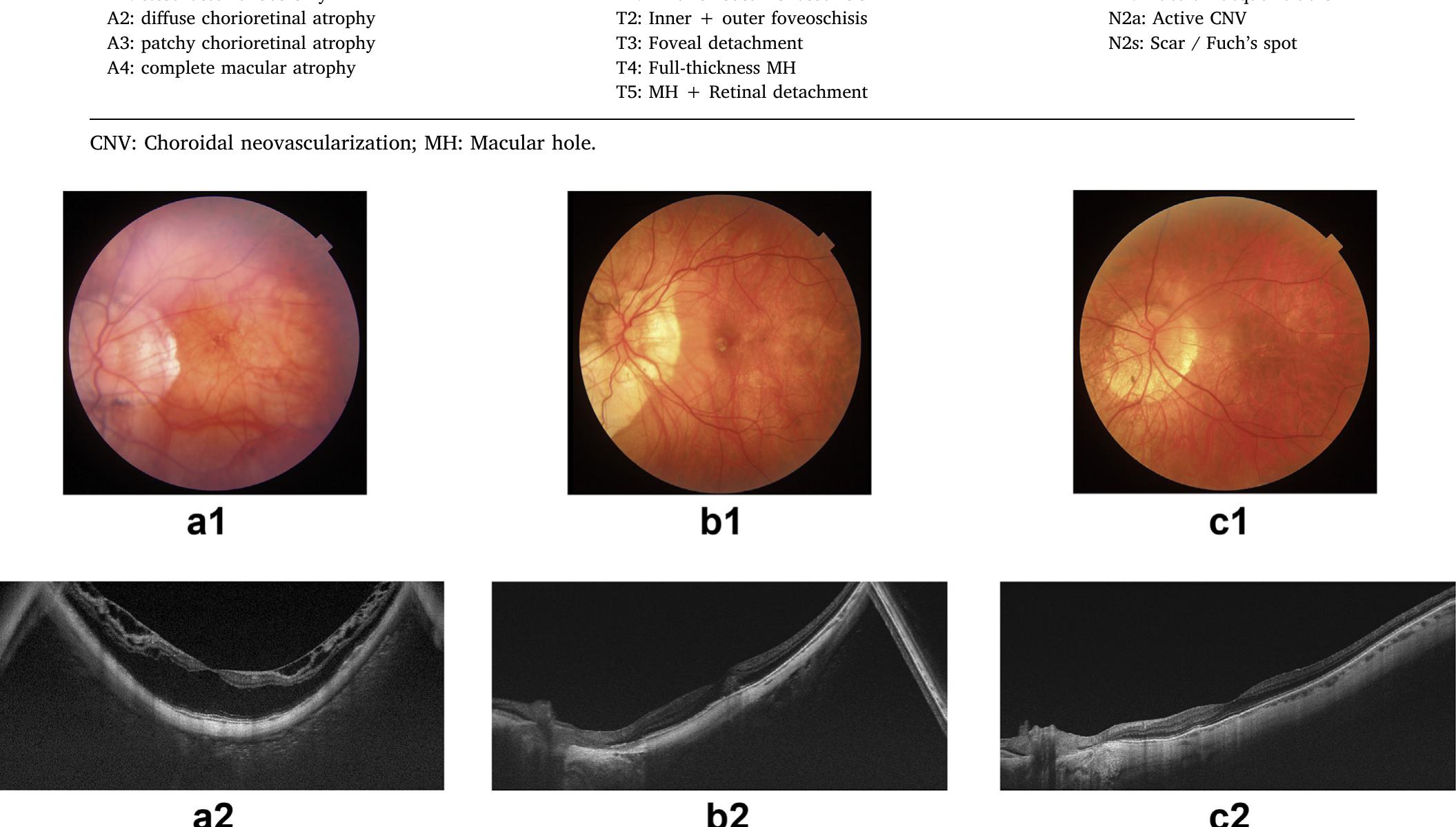 (PDF) Myopic maculopathy: Current status and proposal for a new ...