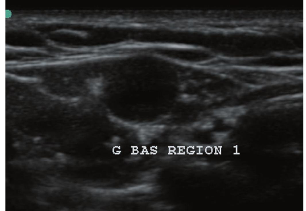 Figure 13 - PICC Zone Insertion Method™ (ZIM™): A Systematic