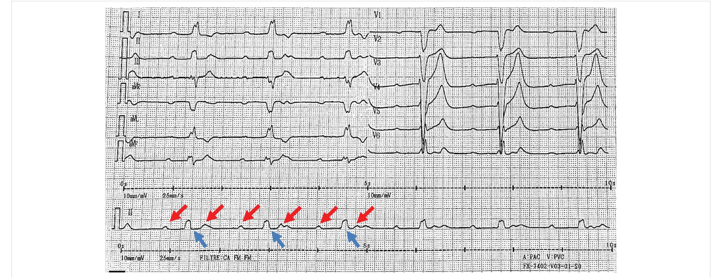 (PDF) Resolved complete atrioventricular block and left ventricular ...