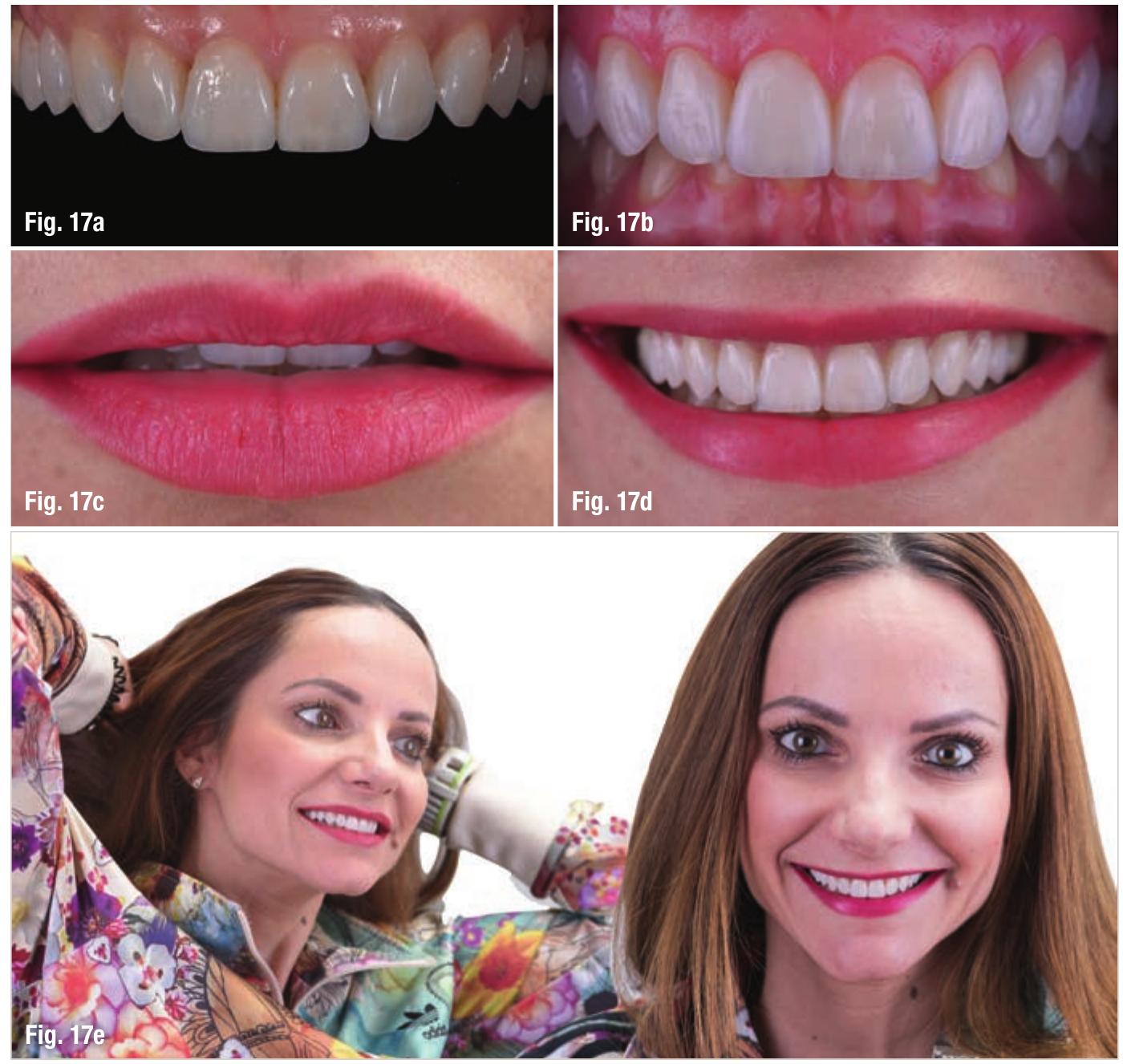 (PDF) Digital vs . analogue workflow on ten ceramic veneers in the maxilla