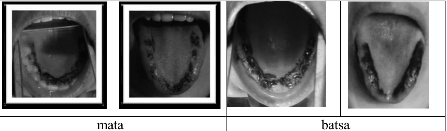 We have observed that all of our five participants use, to a certain extent, the same places of articulation and the same lingual type during the production of the simple dental anc affricate production. Except for one participant M1, who systematically articulated his “simple dental category consonant” at the alveolar zone and affricates at the post-alveola1 zone, all the other four participants show consistency on the production of dentals anc affricates on the dental-alveolar zone. Concerning the lingual configuration, except M3. who seemed to use pure tongue tip (apical) contact, all the other four participants used the tongue blade to produce these two categories.  