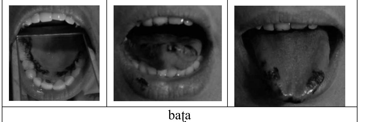 Figure 4: Palatogram (left) and linguograms for Speaker F1. Palatal contact is behind the alveolar ridge. The tongue tip and the rim without retroflexion are used. Type is the typical example of apico-alveolar type described by Pokharel (1989). 