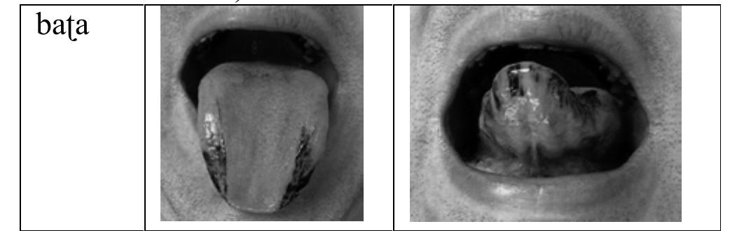 Retroflexion showed an important variation during its production: both the place of articulation and the lingual contact types are affected by this variation. Our result of the second experiment shows that the post-alveolar region is the most “used” region during he production of the retroflex consonants (see Table 4). Only retroflex consonants pronounced in # iCi were produced systematically as the alveolar type. Some more posterior types such as pre-palatal, are also being observed among some participants. Compared to Pokharel’s claim (Pokharel 1989), these posterior types are quite new and are similar to the traditional description of retroflex sounds in South Asian languages Ladefoged and Bhaskararao 1983).  