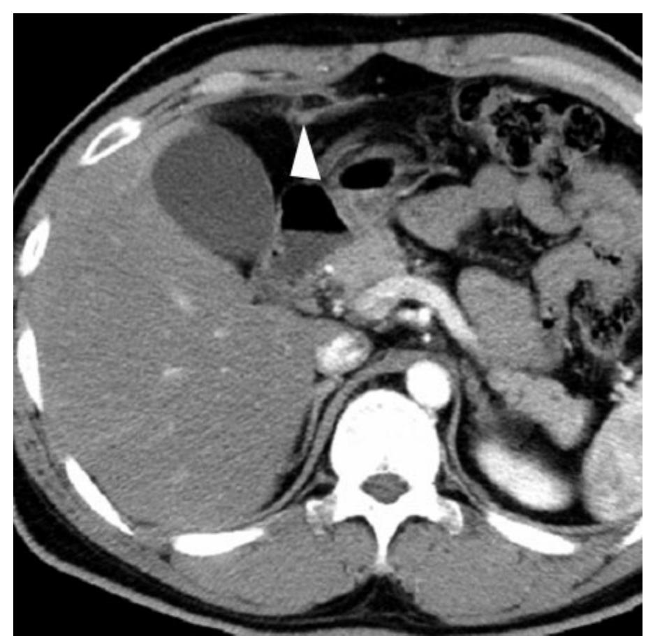 (PDF) The Perihepatic Space: Comprehensive Anatomy and CT Features of ...