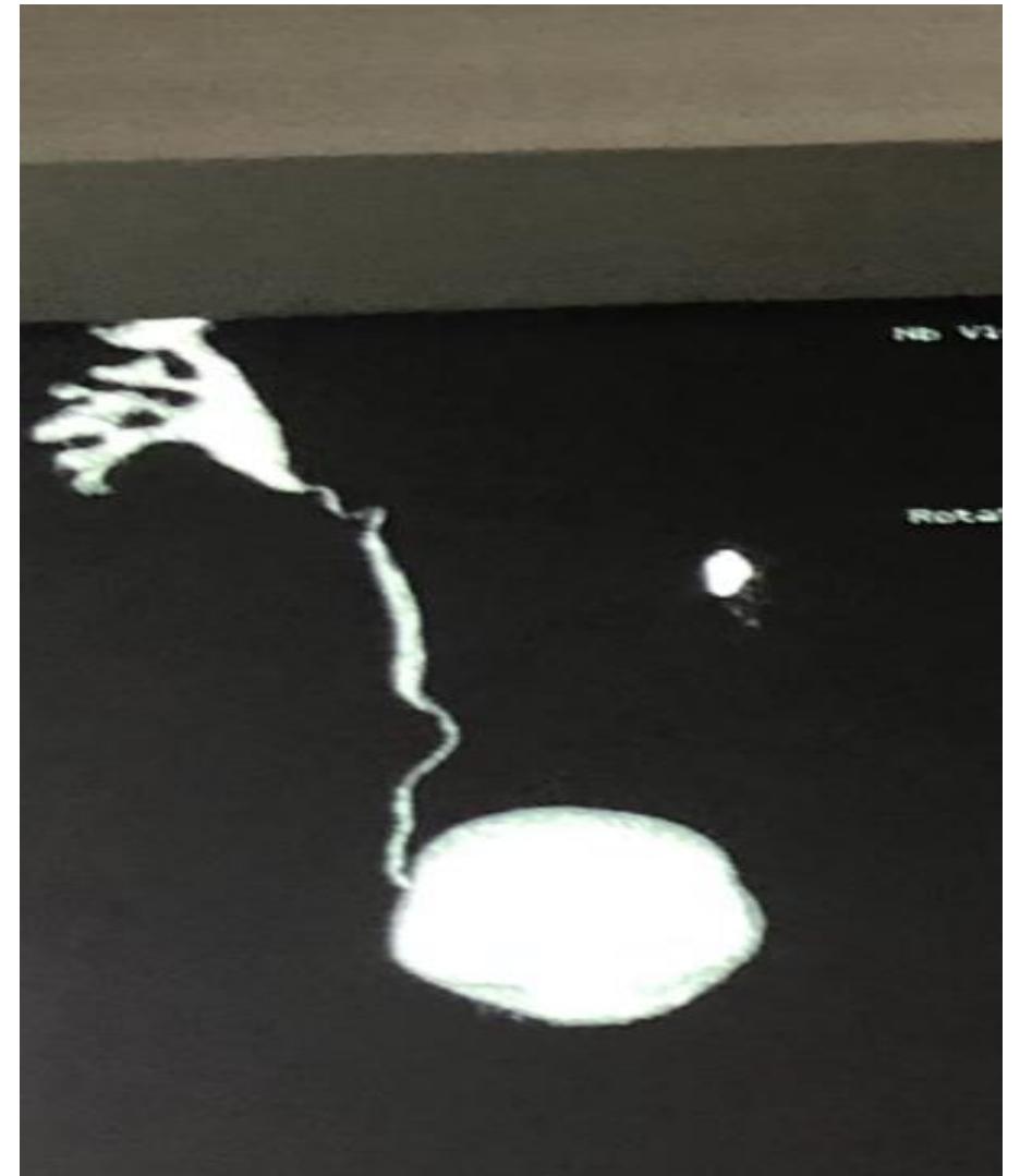 (PDF) The Ureteral Stone Cone is A Useful Device for the Prevention of ...