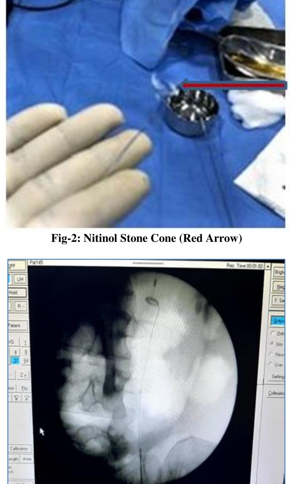 (PDF) The Ureteral Stone Cone is A Useful Device for the Prevention of ...