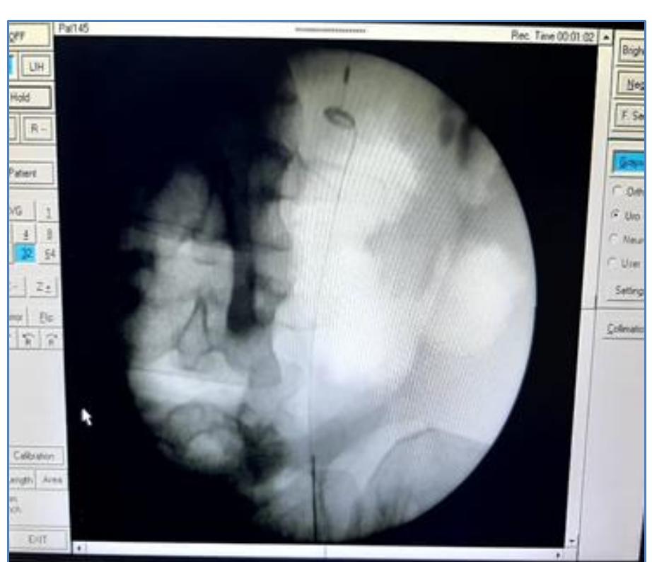 (PDF) The Ureteral Stone Cone is A Useful Device for the Prevention of ...