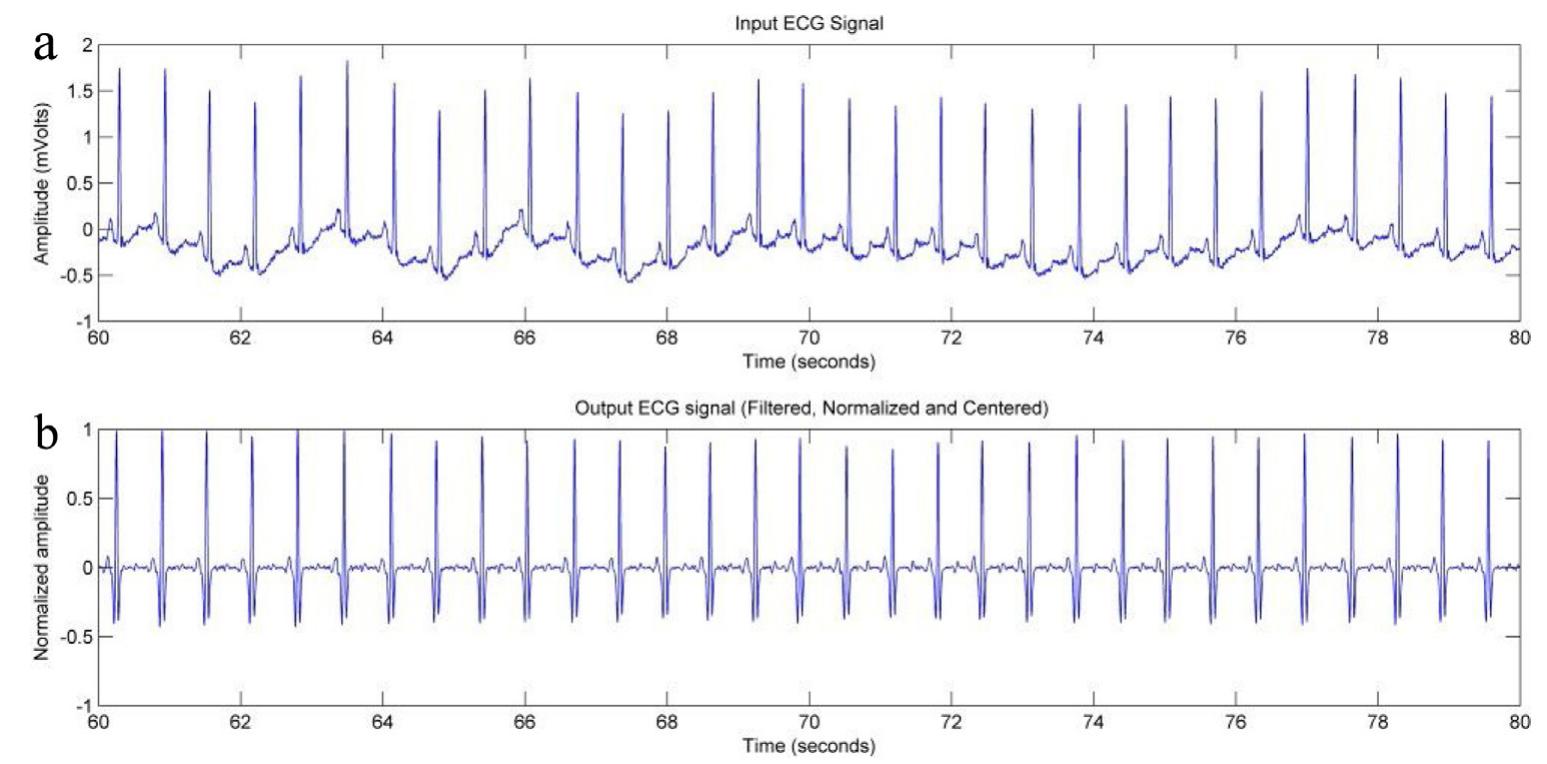 Figure 1 - from A robust QRS complex detection using regular
