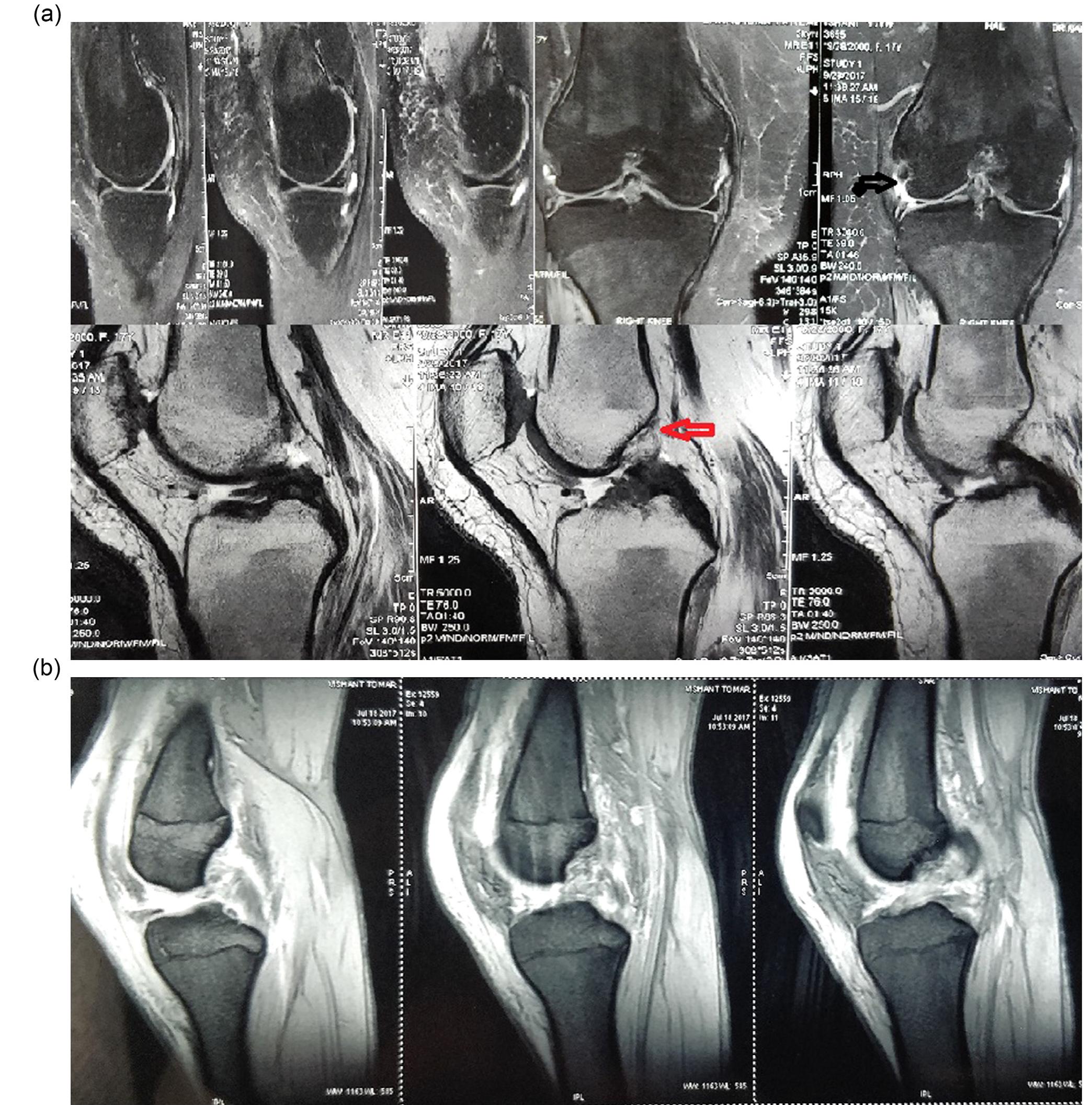 A: showing acl, mcl and medial meniscal injury.