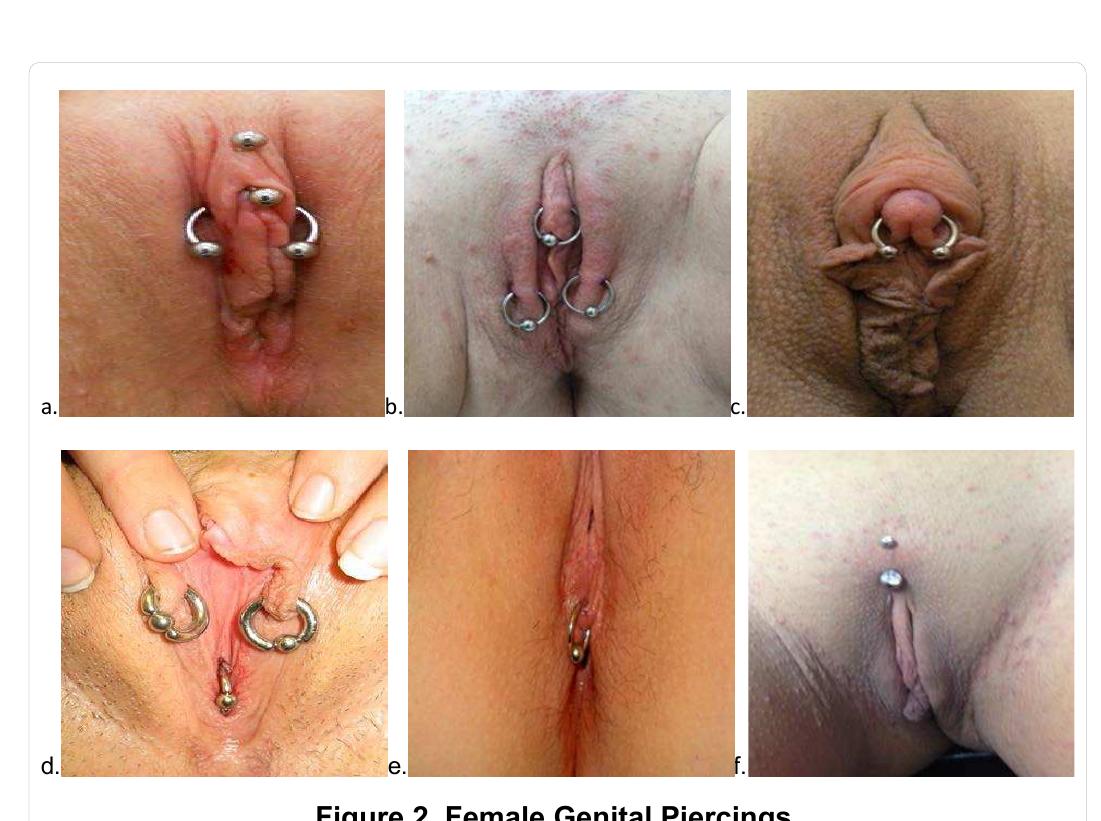 PDF) Complications of Genital Piercings