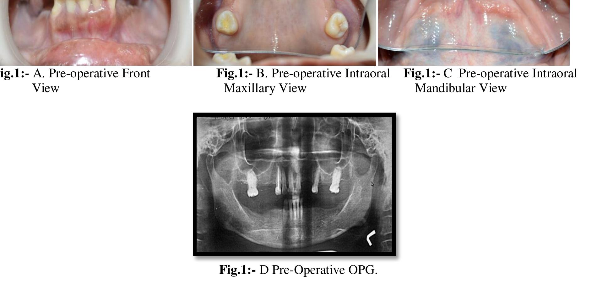 Figure 6 - Cast Partial Denture with Attachment: Boon to