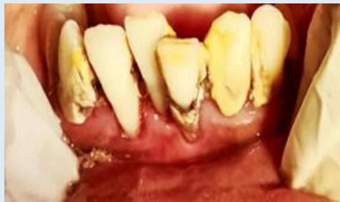 Rotting Gums Figure 2 - from Gingival and Periodontal Diseases Seen in