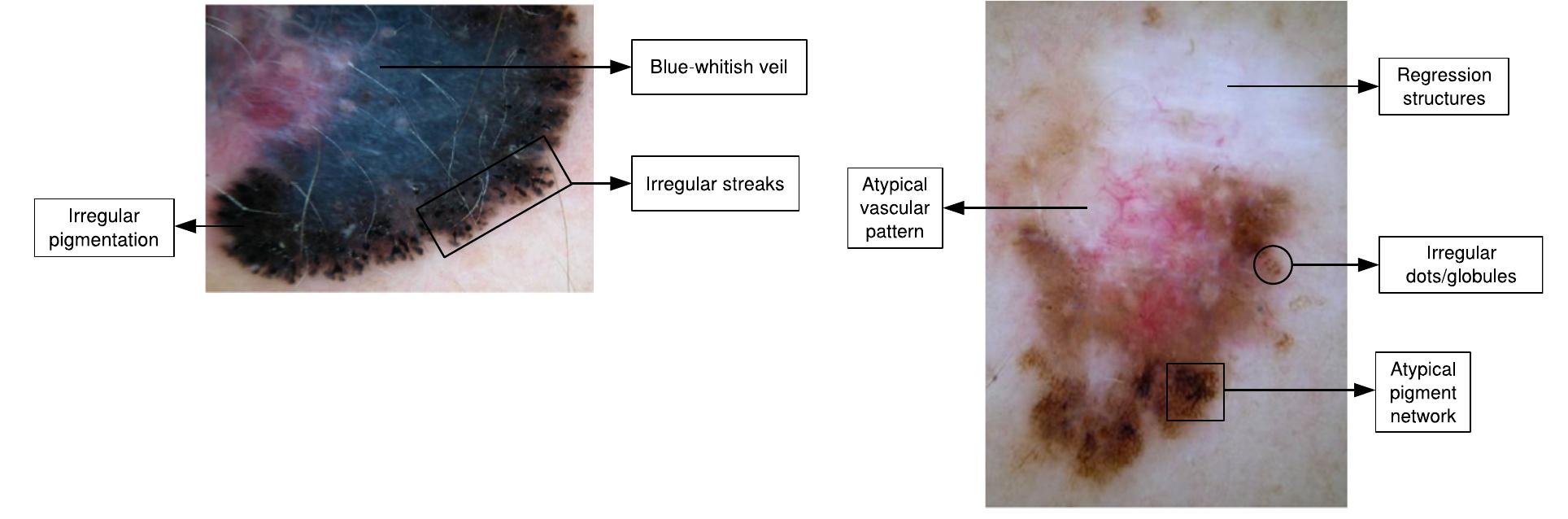 Diffuse Borders Example of melanoma showing a very diffuse border. left: