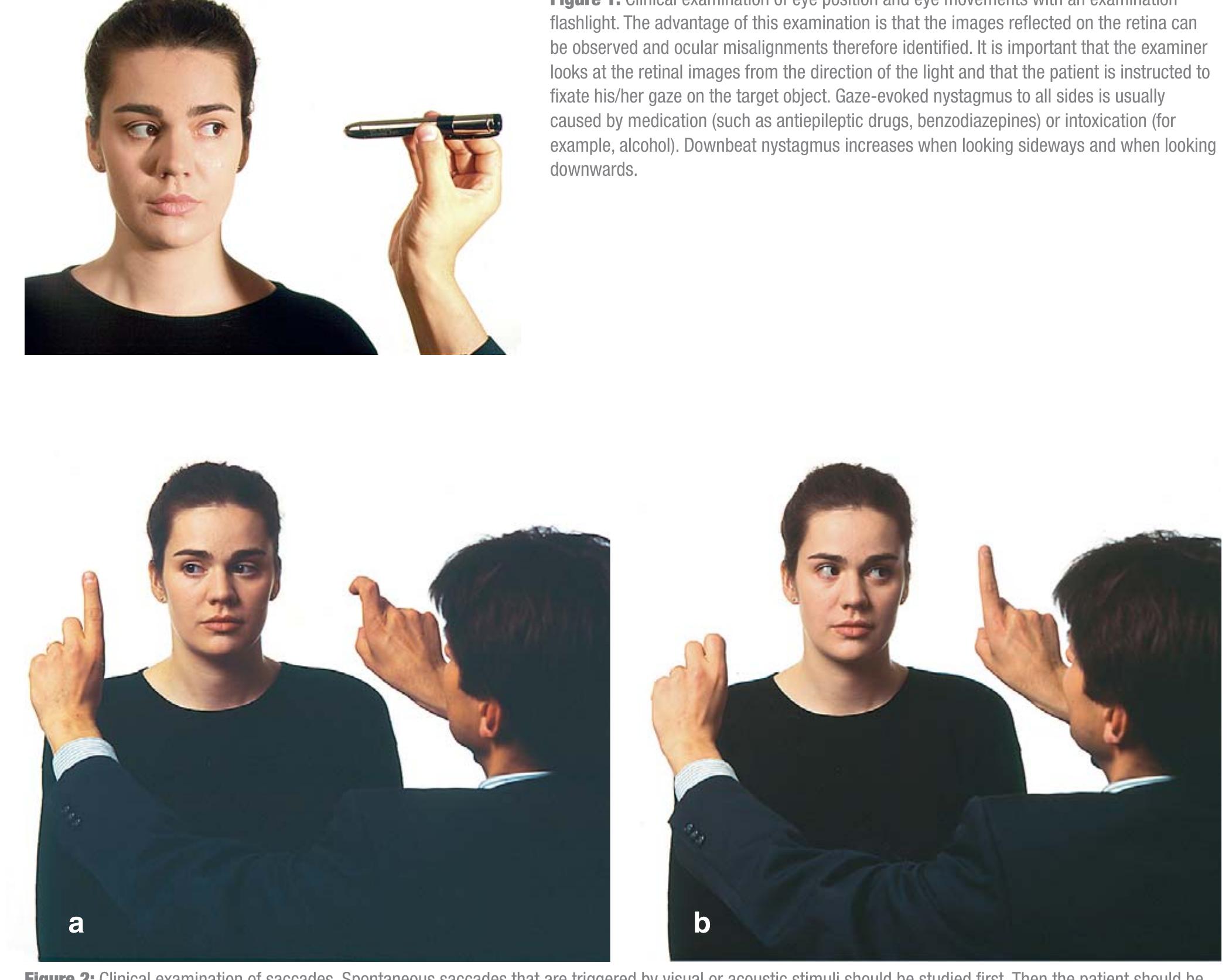 (PDF) Central oculomotor disturbances and nystagmus: a window into the ...