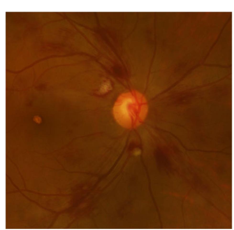 Red Spot Roth Spot (PDF) Roth’s spots