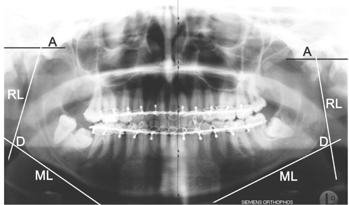 (PDF) Non-surgical treatment of condylar fractures in adults: a ...