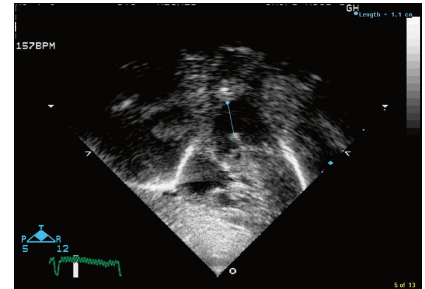 (PDF) Aortopulmonary Window