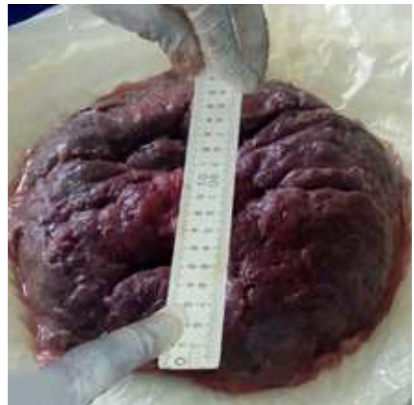 (PDF) Gross Morphological Changes of Placenta Associated with Maternal ...