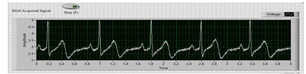 (PDF) Real -Time ECG Signal Acquisition and Processing Using LabVIEW
