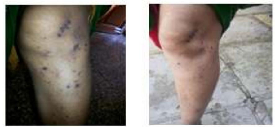 (PDF) Rare case of lichen planus caused by ACE inhibitors
