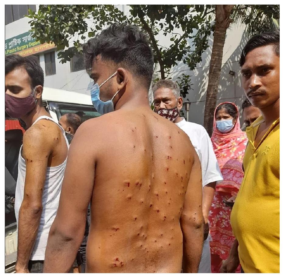 Figure 4: Wounds from rubber bullet fired at workers in Gazipur. Photo: Sheikh Sabiha Alam (Prothom Alo) 