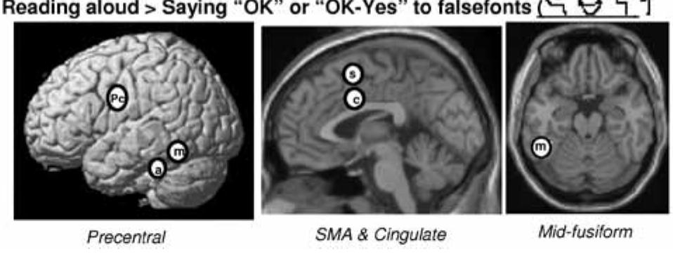Note. cST = central superior temporal cortex. OT = occipitotemporal cortex. pST = posterior superior temporal cortex. PT = posterior temporal cortex. SM = sensory-motor cortex. From “Functional Brain Imaging Studies of Skilled Reading and Developmental Dyslexia,” by C.J. Price and E. McCrory, 2005, in M.J. Snowling and C. Hulme (Eds.), The Science of Reading: A Handbook, Malden, MA: Blackwell, p. 483. 