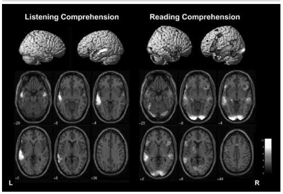 Figure 2. Cortical Areas Active in Listening Comprehension Versus Reading Comprehension in 4-12-Year-Old Children 