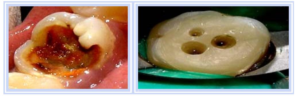 Projecting Tooth (PDF) Pre-endodontic rehabilitation of badly mutilated teeth with canal ...