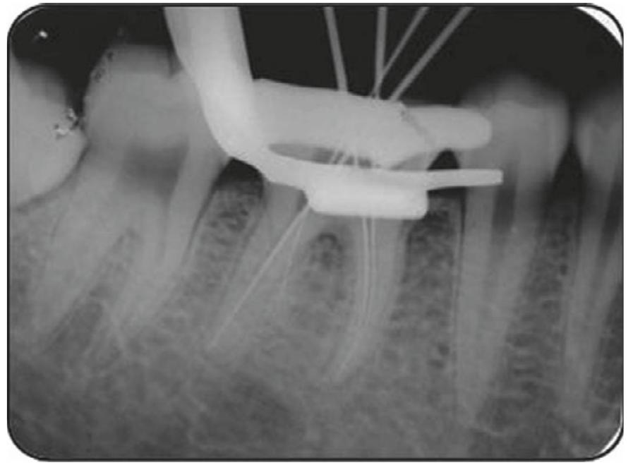 Endo Short Working Length Radiograph Figure 7 - from Radix entomolaris in mandibular first