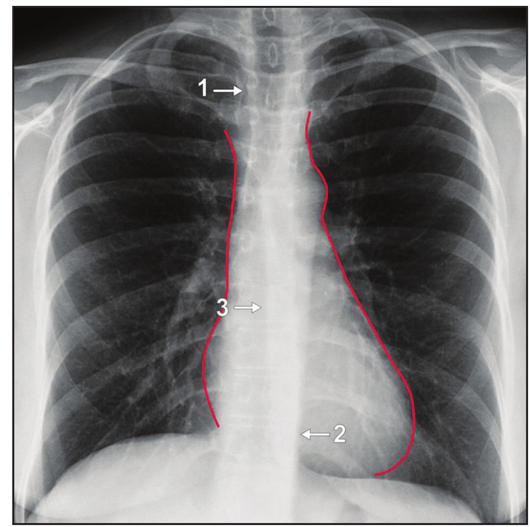 (PDF) Where Are They All Hiding? Common Blind Spots on Chest Radiography