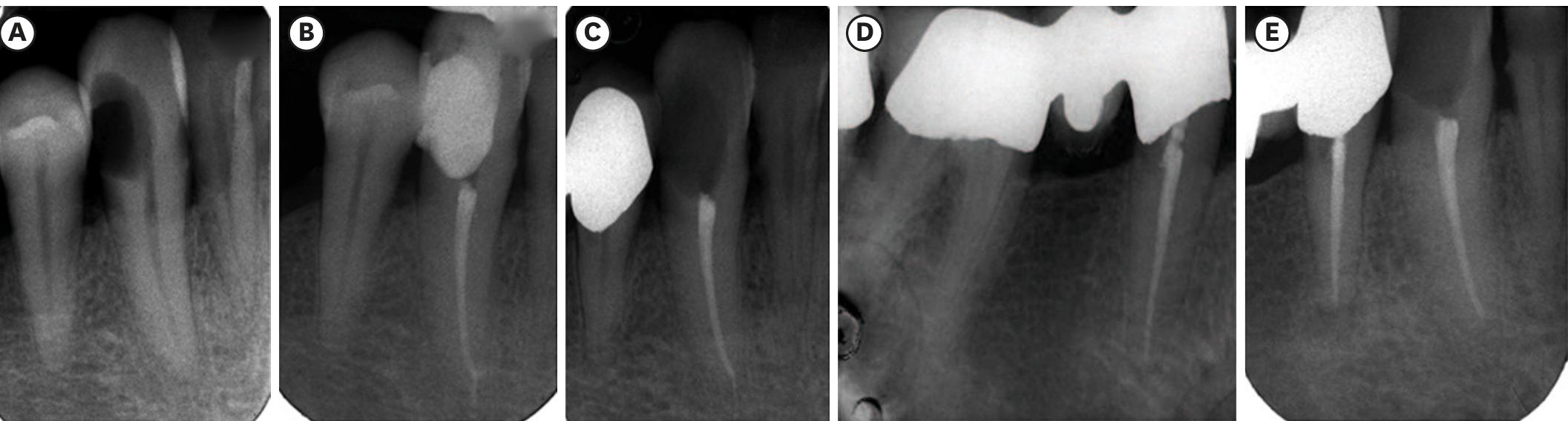 (PDF) The fate of overfilling in root canal treatments with long-term ...