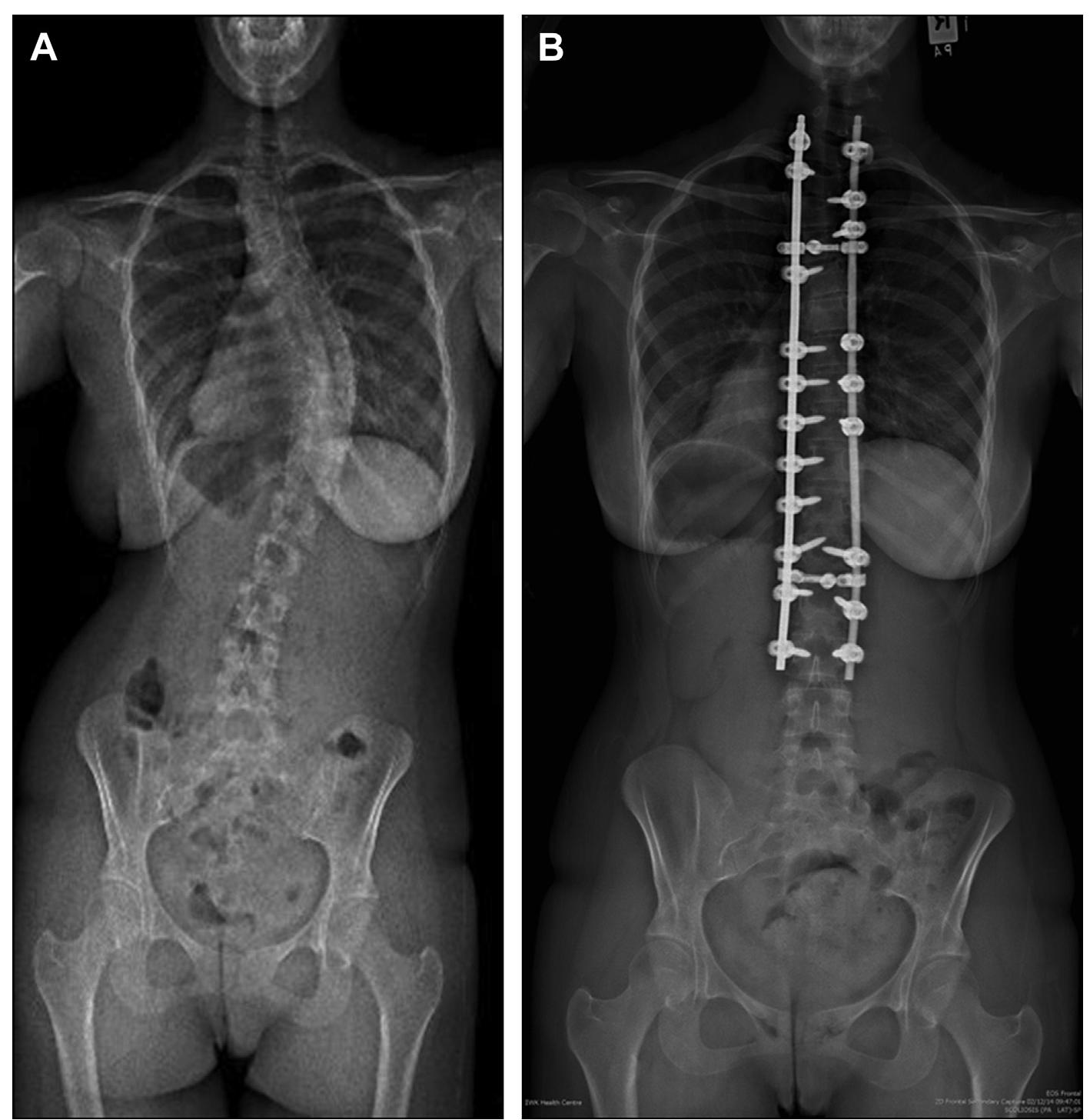 Sitting radiographs of a 13-year-old boy with scoliosis