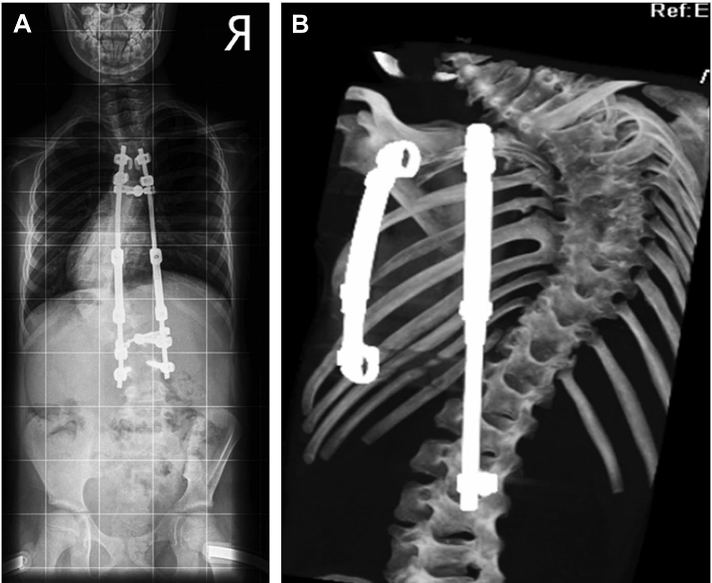 (PDF) Update on Evaluation and Treatment of Scoliosis