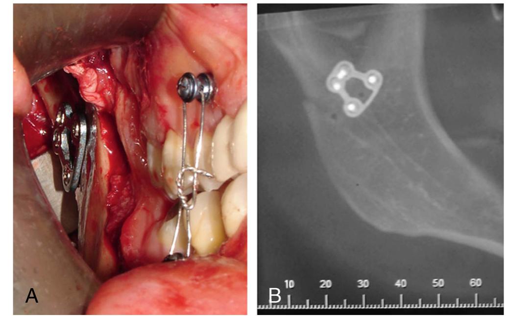 (PDF) Management of Subcondylar Fracture by Intraoral Approach