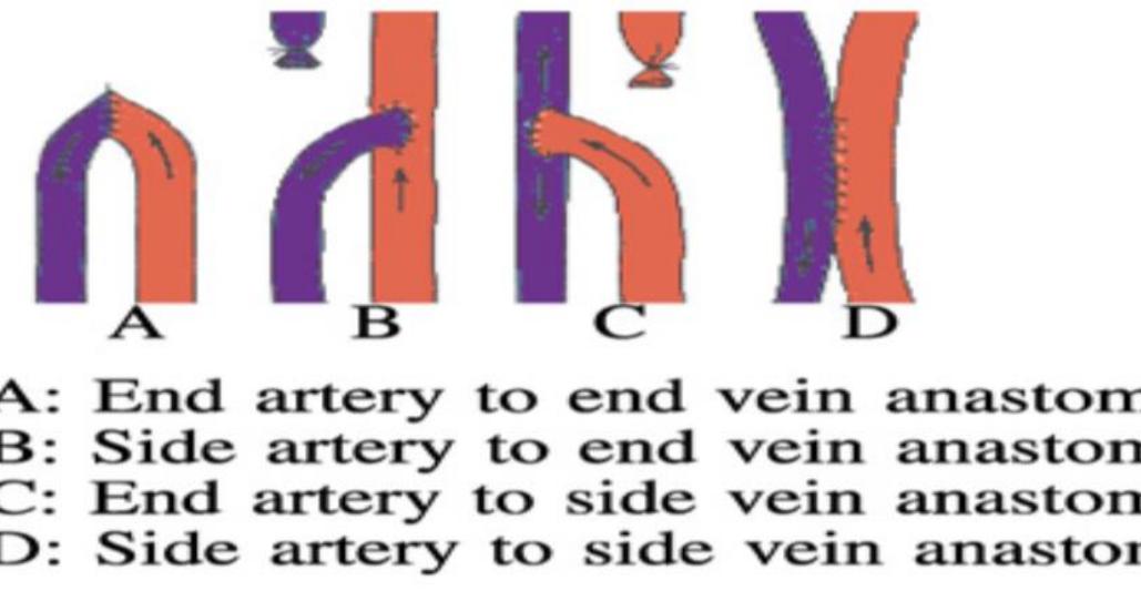(PDF) Arteriovenous Fistula Creation for Renal Dialysis: Early and Long ...