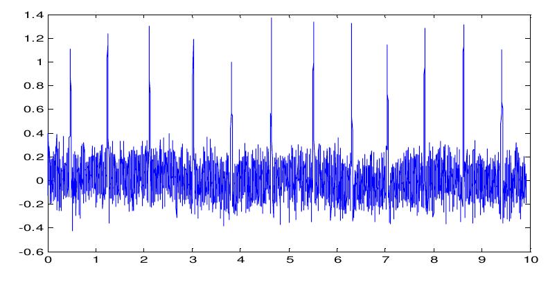(PDF) Cancellation of Motion Artifact Noise and Power Line Interference ...