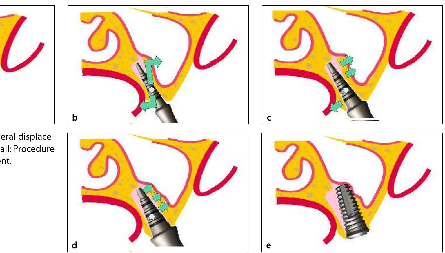 Figure 1 - from Lateral Displacement of Maxillary Sinus