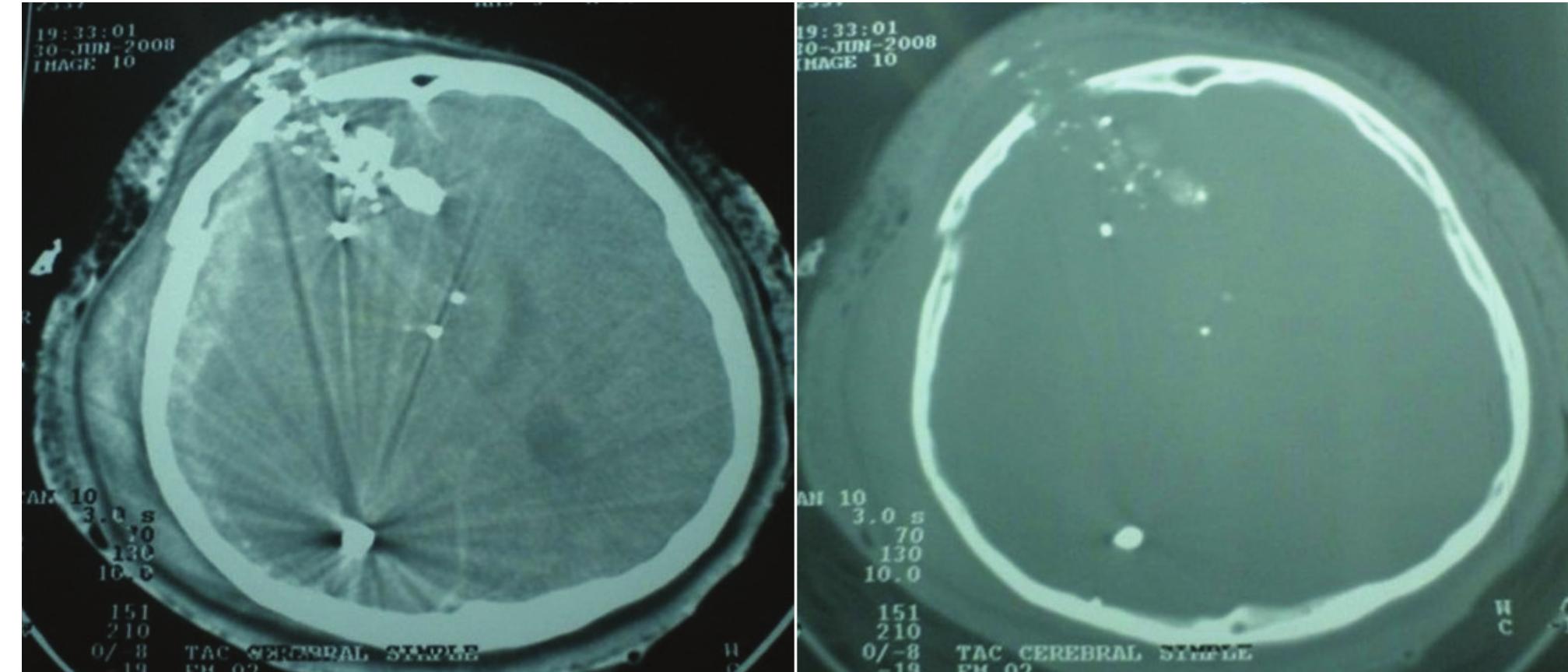Shrapnel Injuries Bone (PDF) Craniocerebral Gunshot Injuries; A Review of the Current Literature
