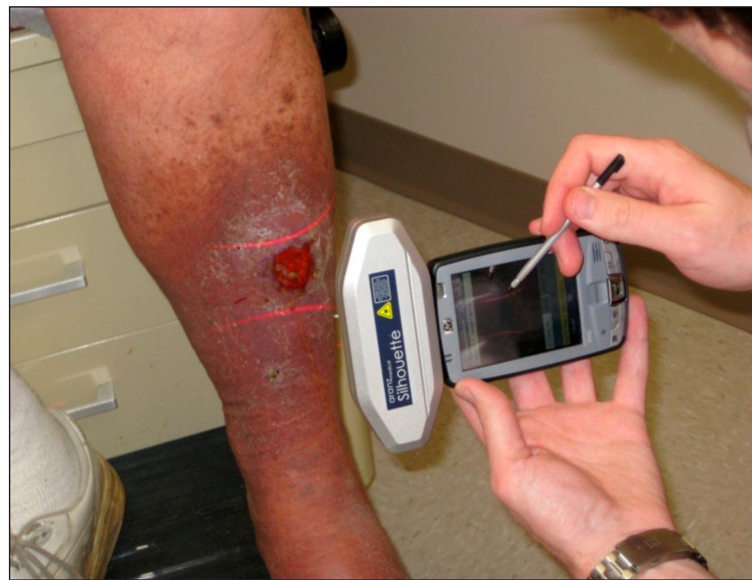 (PDF) Digital Planimetry Results in More Accurate Wound Measurements: A ...