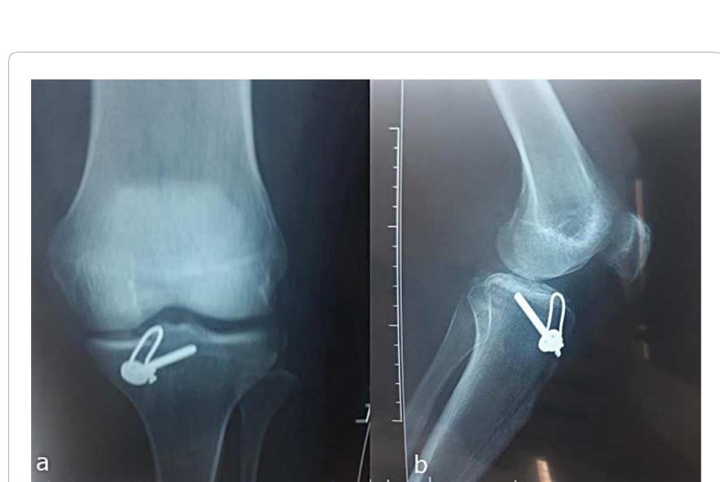 Figure 2 - from Tibial Spine Avulsion Fractures: Current