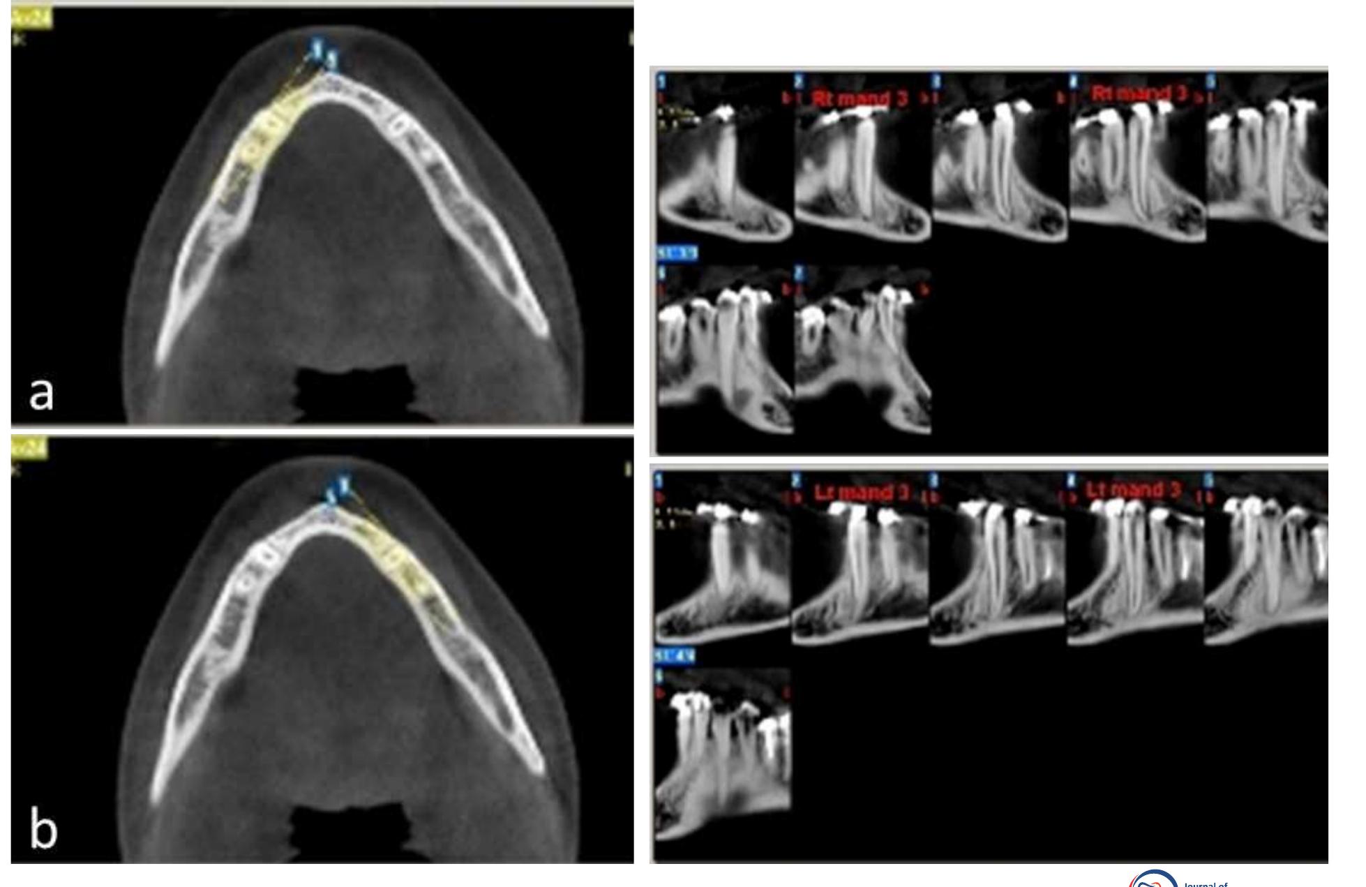 Follow up radiography after 24 month ofcd syndrome is an