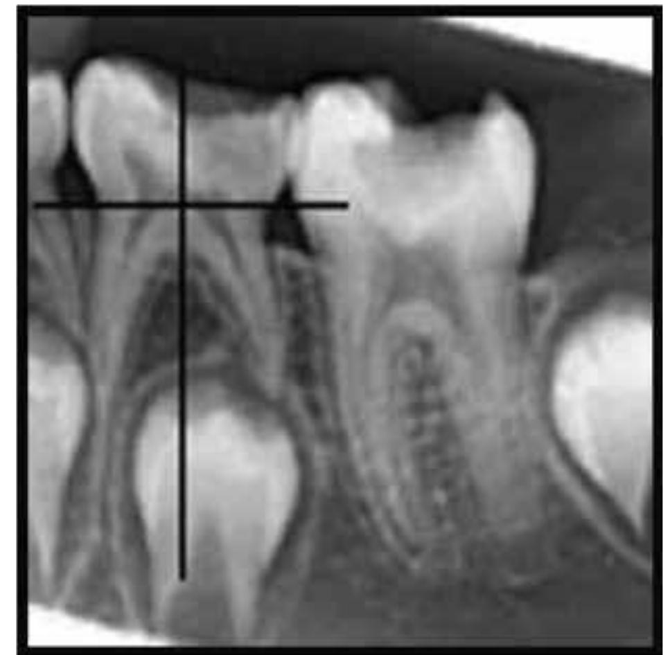 Root Resportion Radiographs (PDF) Root Resorption Patterns of Primary Mandibular Molars and ...